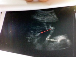 Ultrasound | It's a Boy
