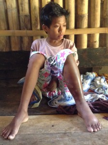 Joshua's very swollen, infected leg.