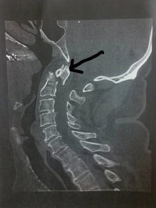 xray-of-broken-neck-cropped