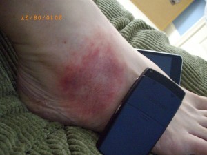 day 7 skin irritation